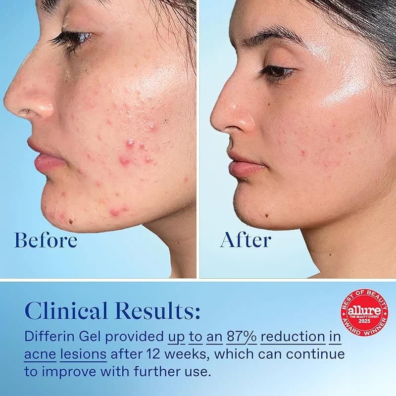 Differin Acne Treatment Gel — image 6
